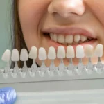 Carillas dentales: transforma tu sonrisa sin cirugía